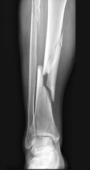 Tibial Fractures