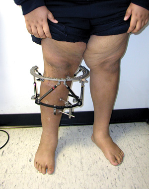 An adolescent male patient with left-sided Blount dis- ease who continued to gain weight despite realign- ment of his leg. (Photo courtesy of Sanjeev Sabharwal, MD, MPH.)