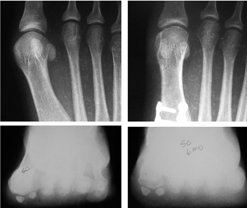 A new triplanar paradigm for bunion management | Lower ...