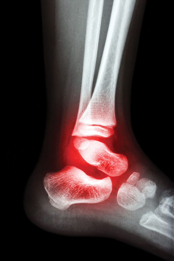 What do you do in the hospital after an arthrodesis operation to fuse the ankle?