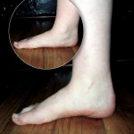 Orthotics: Management of functional flat foot