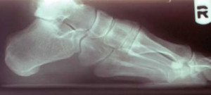 Figure 1. Radiograph of functional hallux limitus. Note the lack of joint destruction in this joint with functional limitation of motion.