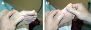 Figure 3. Positive functional hallux limitus test. A: A load is applied to the first metatarsal head to simulate ground reaction force. B: As dorsiflexion of the toe is attempted, there is a jamming at the first metatarsophalangeal joint.