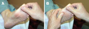 Figure 7. Pre-loading the hallux slightly (A) in a patient with FnHL will faciliate dorsiflexion when pressure is applied to the first metatarsal (B). 
