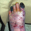 Arterial disease: Lower extremity implications