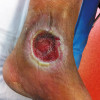Diabetes experts focus on foot ulcer recurrence