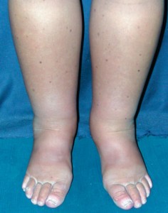 2-lymphedema