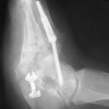 Deformity and diabetes dictate surgical strategy