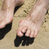 Handicapping hallux valgus