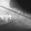 Adult acquired flatfoot: Nonoperative options