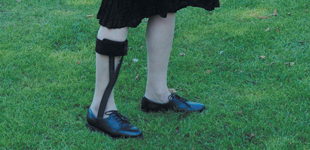 When diabetes complicates drop foot