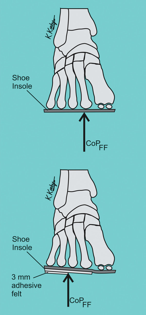 medial heel wedge orthotics
