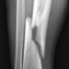 Compartment syndrome following tibia fracture