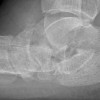 When foot-ankle issues complicate knee surgery