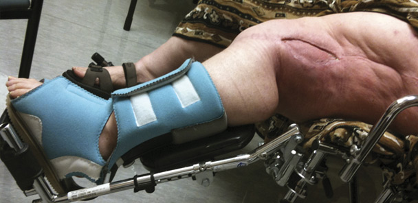 Amputation vs salvage for lower limb tumors