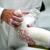 Clubfoot conversion: Nearly all surgeons adopt Ponseti method