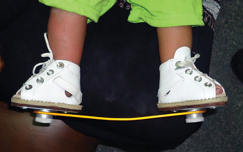 CONFERENCE COVERAGE: International Clubfoot Symposium