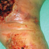 Exploring mechanisms of diabetic foot ulceration