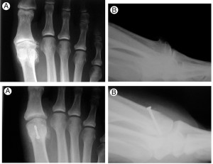 ￼Radiographs show preoperative appearance (top row) and postoperative appearance (bottom row) of grade IV hallux rigidus. A = anteroposterior view, B = lateral view. (Images reprinted with permission from reference 10.)