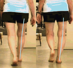 Visual representation of the observed varus thrust from two sequential video frames (initial contact on the left, early stance on the right.) Note the lateral displacement of the right knee during early stance as evidenced by increased tibial varus and interknee displacement. (Reprinted with permission from reference 11.)
