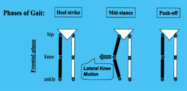 The role of varus thrust in knee osteoarthritis