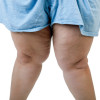 BMI and TKA: Obese patients do benefit from surgery