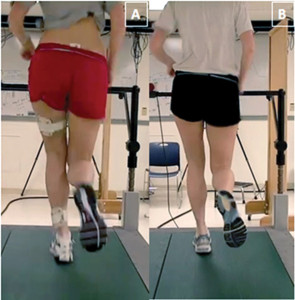 Figure 1: Female runner with patello- femoral pain syndrome demonstrating a large reduction in medial collapse me- chanics from pre-mirror gait retraining (left) to post-retraining (right). Note the increase in distance between the knees and reduction in contralateral pelvic drop.
