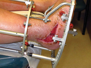 Figure 1. This man, aged 51 years, underwent Charcot reconstruction of the hindfoot and ankle. He developed a postoperative wound dehiscence on the lateral aspect of the foot, which required more than three months of local wound care for closure.