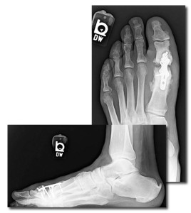 Figure 2. This man, aged 56 years, who had sensory neuropathy and received a new diagnosis of diabetes after surgery, underwent first metatarsophalangeal fusion with enhanced plate fixation. He developed nonunion of the joint mostly due to diabetic osteolysis, as evidenced by resorption at the joint. His postoperative glycated hemoglobin level (when diabetes was diagnosed) was 10.8%