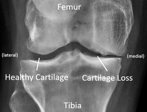 Figure 2: Standing knee x-ray for an individual with medial compartment knee os- teoarthritis. The loss of articular cartilage is evident in the narrower gap in the medial compartment.
