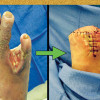 Diabetic limb salvage: Surgeon's perspective