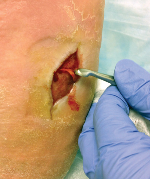 Figure 1. Plantar midfoot wound with evident thick biofilm layer on debridement. (Photo courtesy of John Steinberg, DPM.)