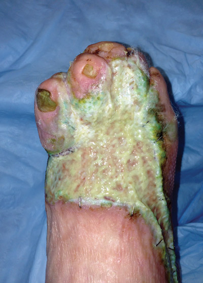 Figure 2. Dorsal foot wound status post grafting with pseudomonas infection and thick biofilm destruction of the graft. (Photo courtesy of John Steinberg, DPM.)