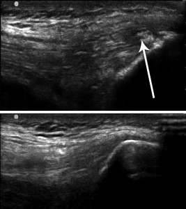 Figure 1. Intratendinous calcification at the insertion of the quadriceps tendon into the patella (above) versus a normal quadriceps tendon (below).