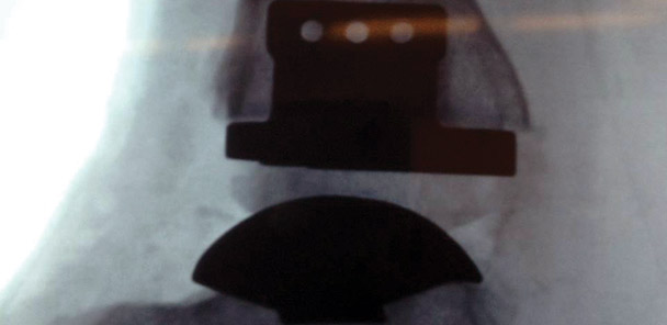 Ankle arthroplasty makes strides, but issues remain