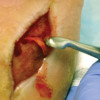 Biofilms: Diabetic foot ulcer care gets personal