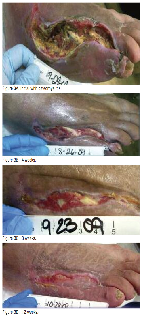 Biofilms: Diabetic foot ulcer care gets personal | Lower Extremity