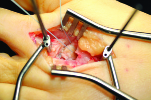 Figure 7: Plantar plate with mattress suture in place.