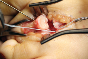 Figure 8: Oblique bone tunnel with suture passer in place to pass suture securing plantar plate into proximal phalanx.