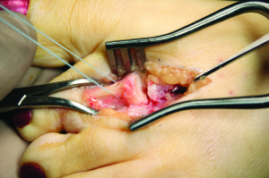 Figure 9: Sutures securely in place through bone tunnels pulling plantar plate into proximal phalanx.