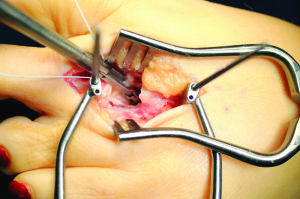 Figure 6: Mini Scorpion (Arthrex) grasping plantar plate and engaging suture.