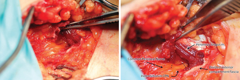 Figure 3. Photos illustrate release of common peroneal nerve. (Photographs courtesy of D. Scott Nickerson, MD.)
