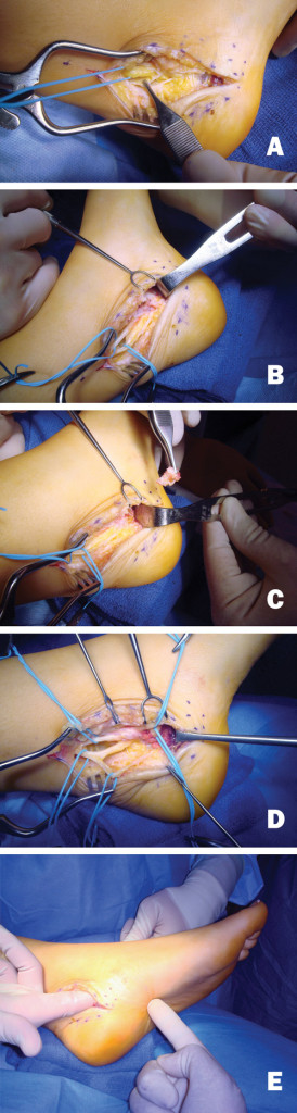 Figure 2. Dellon performed nerve decompression in a patient with a history of failed tarsal tunnel surgery performed by a different surgeon. A. The forceps holds the floor retinaculum, where there has been no previous surgery, and the tibial nerve is visible. B. The tibial nerve has been freed from scar tissue, and the medial and lateral plantar nerves are seen. C. The roofs of the medial and lateral plantar tunnels have been opened and the septum between the two tunnels is removed. D. The calcaneal nerve can be seen coming from the lateral plantar nerve. E. The surgeon’s finger can pass into the bottom of the foot. (Photos courtesy of A. Lee Dellon, MD, PhD).