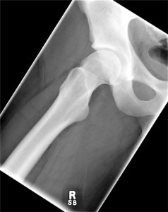 Figure 1. AP radiograph taken in the Dunn position shows a hip with cam-type FAI.