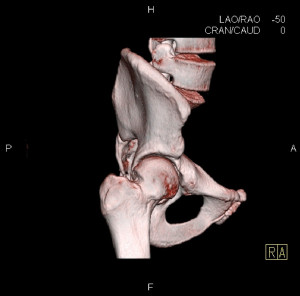 Figure 2. CT scan with 3D reconstructions of a hip with cam-type FAI. 