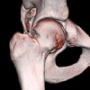 Painful hip impingement: Functional implications