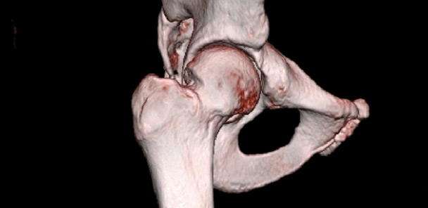 Painful hip impingement: Functional implications