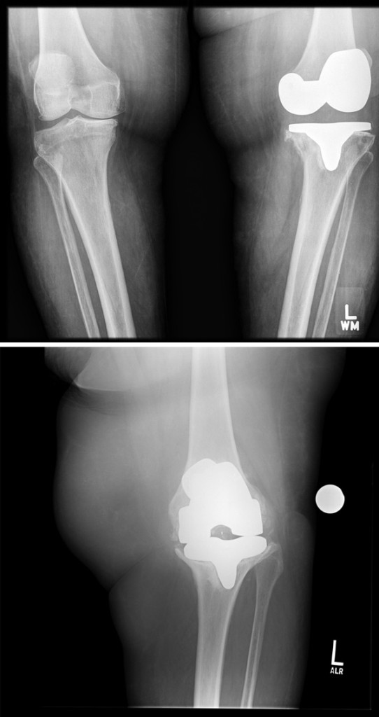 Figure 2. Radiographic images of an aseptically loose tibial implant in a morbidly obese patient.