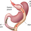 Bariatric surgery: Effects on patient gait and function