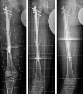 X-rays show femur with nail inserted before length- ening (left), after lengthening (center), and after the lengthened bone has healed (right). (Images courtesy of John Herzenberg, MD, FRSCS.)